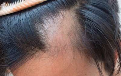 Regenera Activa – regenerative medicine with micrographs for androgenic alopecia