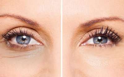 eMatrix Skin Tightening and Rejuvenation around the Eyes