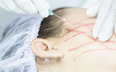 Thread lift – face, body, neck