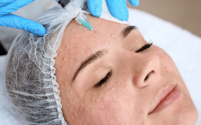 Biorevitalisation  – Prevent ageing changes and rehydrate your skin