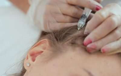 Exosomes hair loss therapy vs PRP hair loss treatment