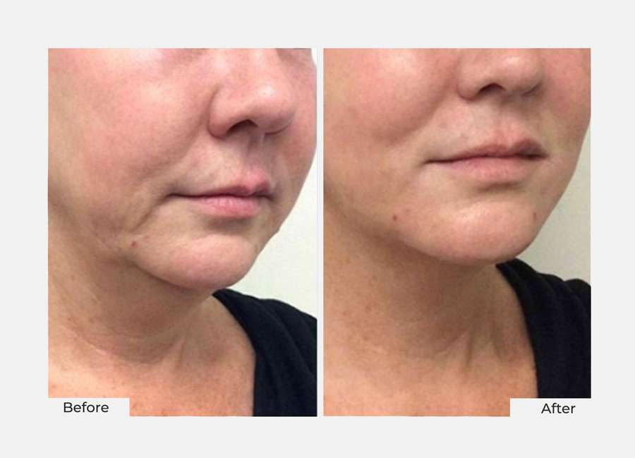 facial-thread-lift-aestha-clinic-1 facial thread lift