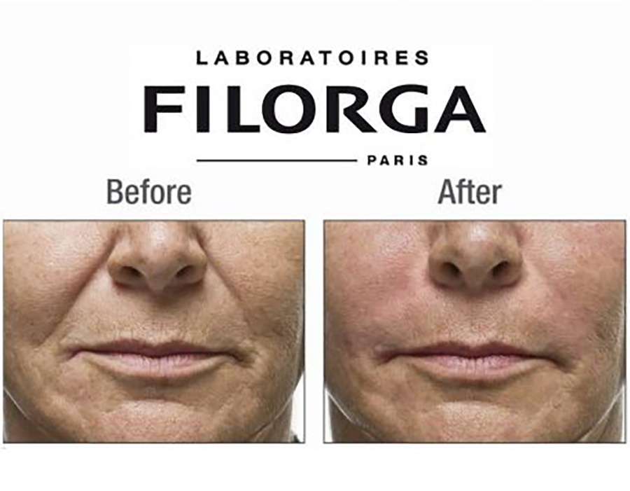 filmed-skinbooster-aestha filorga nctf