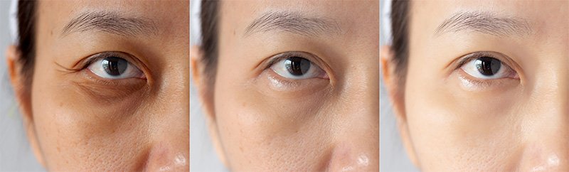 eye rejuvenation