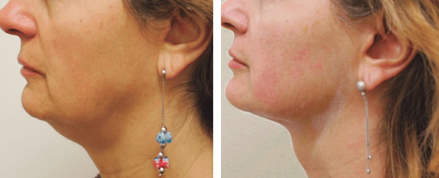 HIFU-Skin-Tightening-34