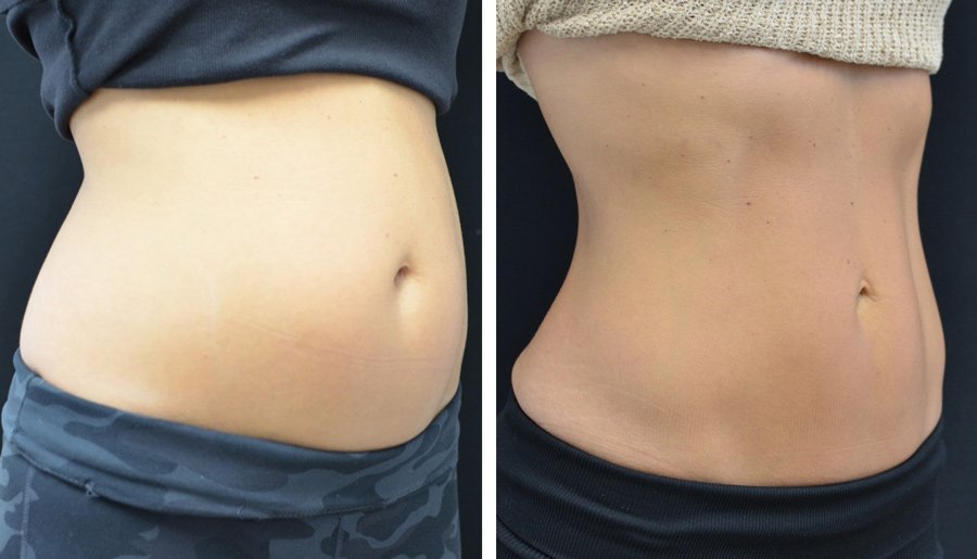 emsculpt-neo-fat-loss-89 spf50