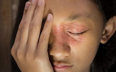 Profhilo – Proven Treatment for Eczema and Psoriasis