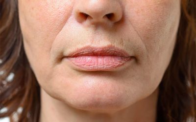 Jowls and Lower Face Laxity Treatments