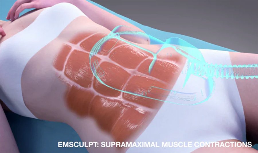 Emsculpt-Neo-vs-Emsculpt emsculpt
