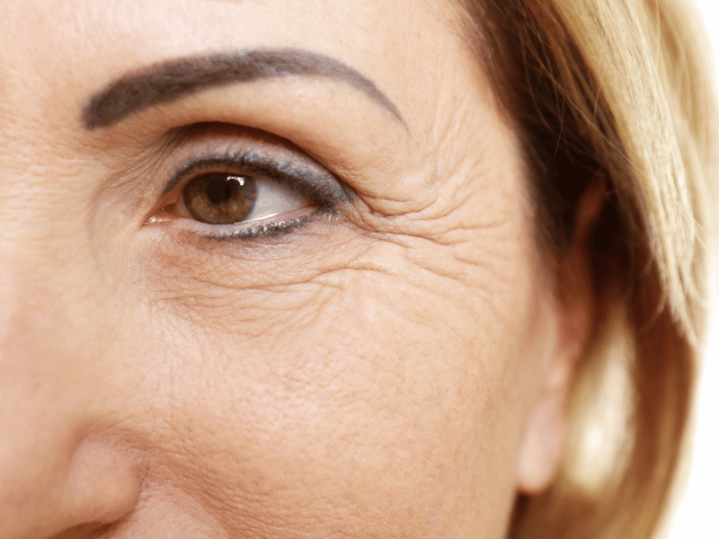 11 Effective Under-Eye Wrinkle Treatments | Aestha Clinic