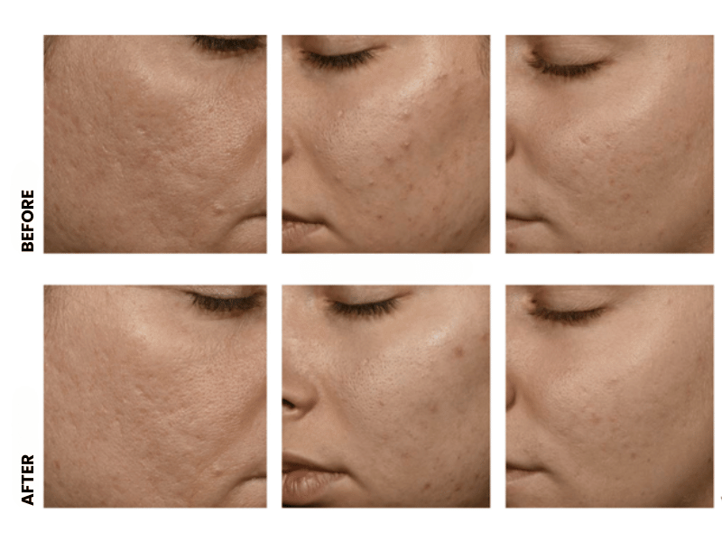 biomimetic peptides biomimetic peptides before and after results