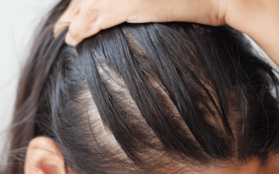 Hormonal Hair Loss in Women
