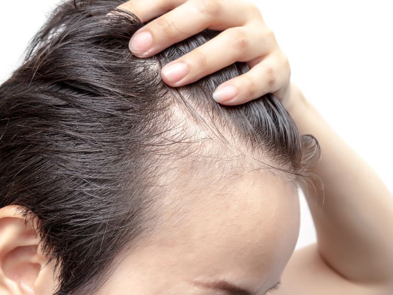 rf microneedling alopecia treatment biomimetic peptides