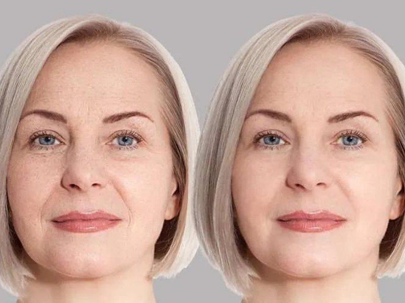 Texture Irregularities CO2 Laser Treatment