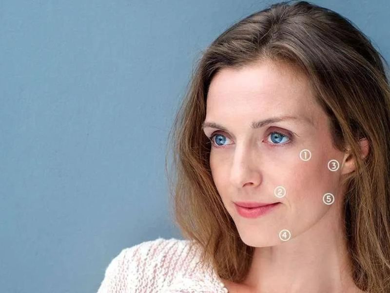 Fine lines and laxity profhilo
