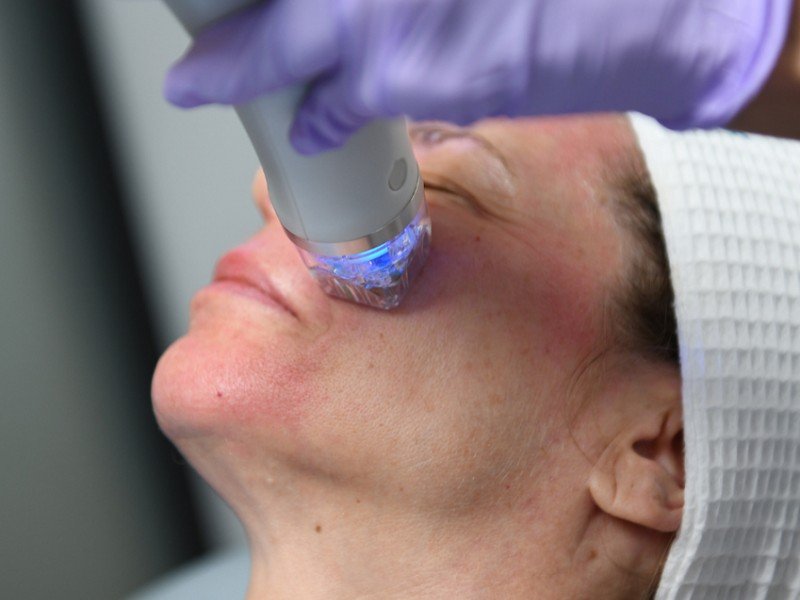 secret pro laser treatment