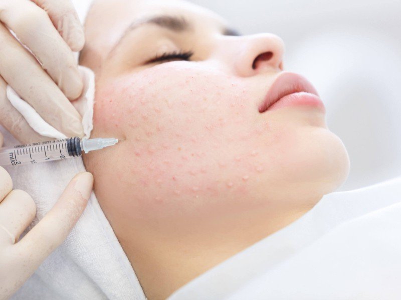 skin boosters