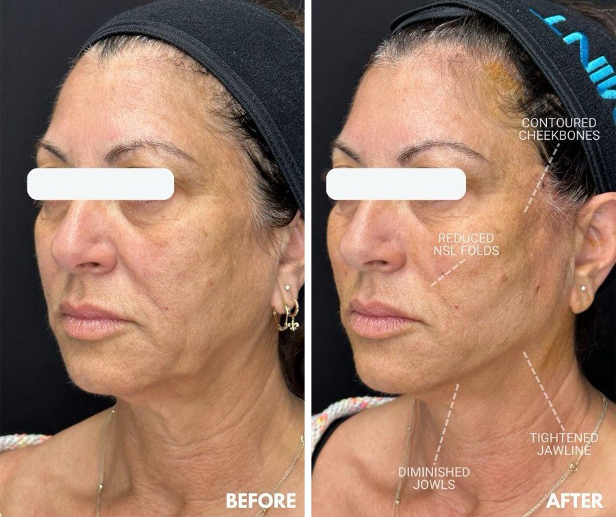 THREADLIFT-683674