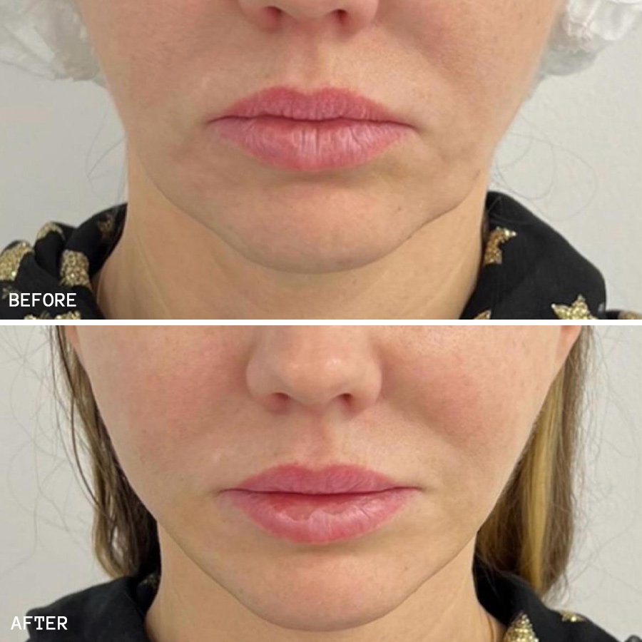 THREADLIFT-78274