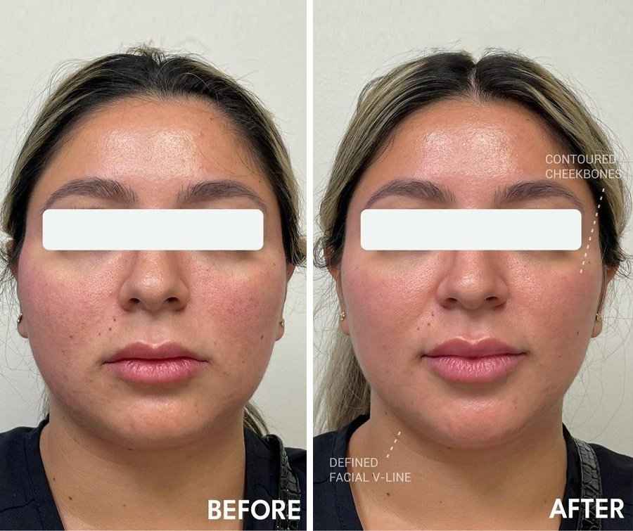 THREADLIFT-8756