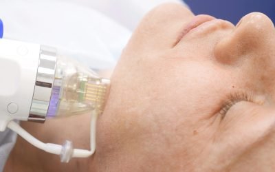 Radiofrequency Microneedling: Unravelling the Benefits and Dispelling the Myths