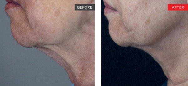 courtesy_of_h_shiffman_md fotona 4D