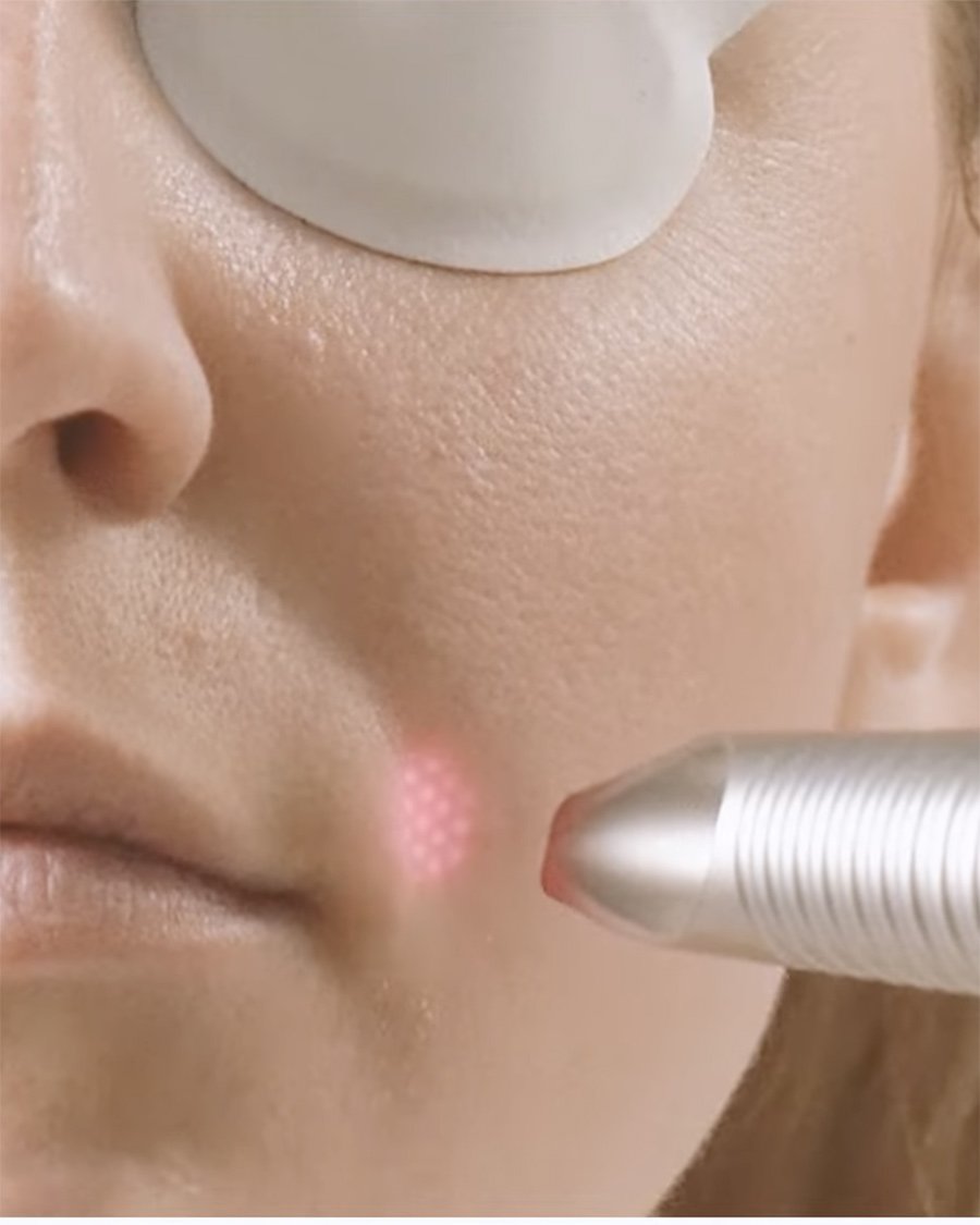 fotona-4d-laser