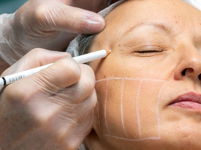 fotona 4d vs hifu 78 rf microneedling