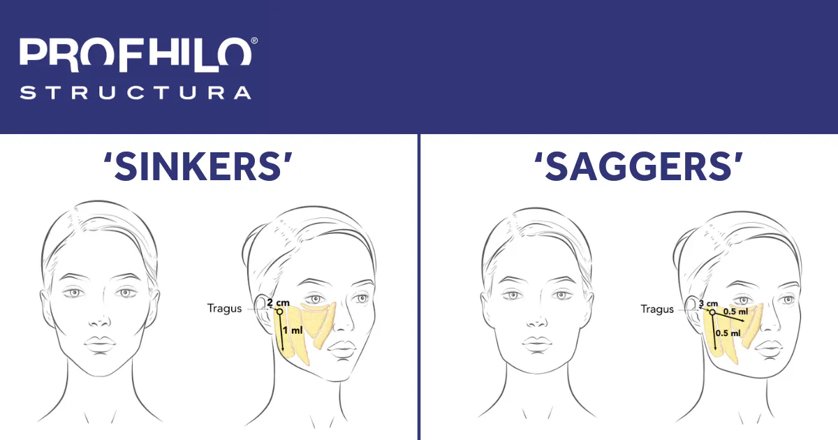 ZmMMgZm069VX1jey_ARTICLEPROFHILOSTRUCTURASINKERSANDSAGGERSINJECTIONTECHNIQUESANDINDICATIONS-HarleyAcademyaestheticmedicinetrainingcoursesnearmeLondon.png profhilo structura