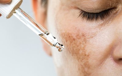 Melasma Awareness Month – Everything You Need to Know