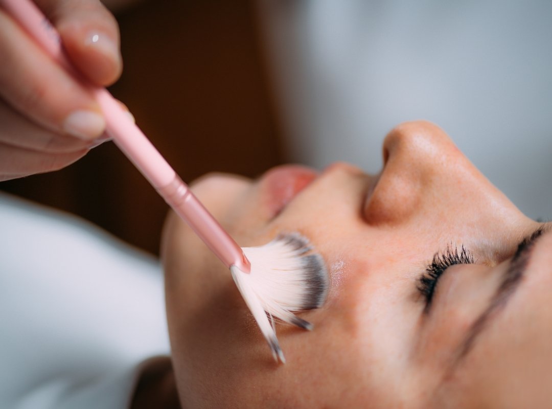 aestha clinic melasma treatment (2332) melasma awareness