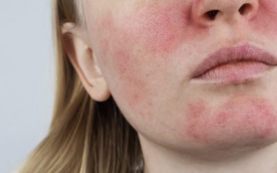 Fotona Laser Treatment For Rosacea
