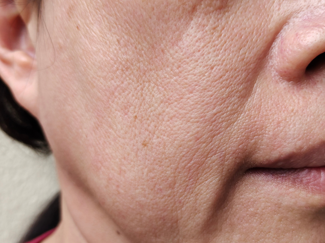 fine lines and wrinkles 23