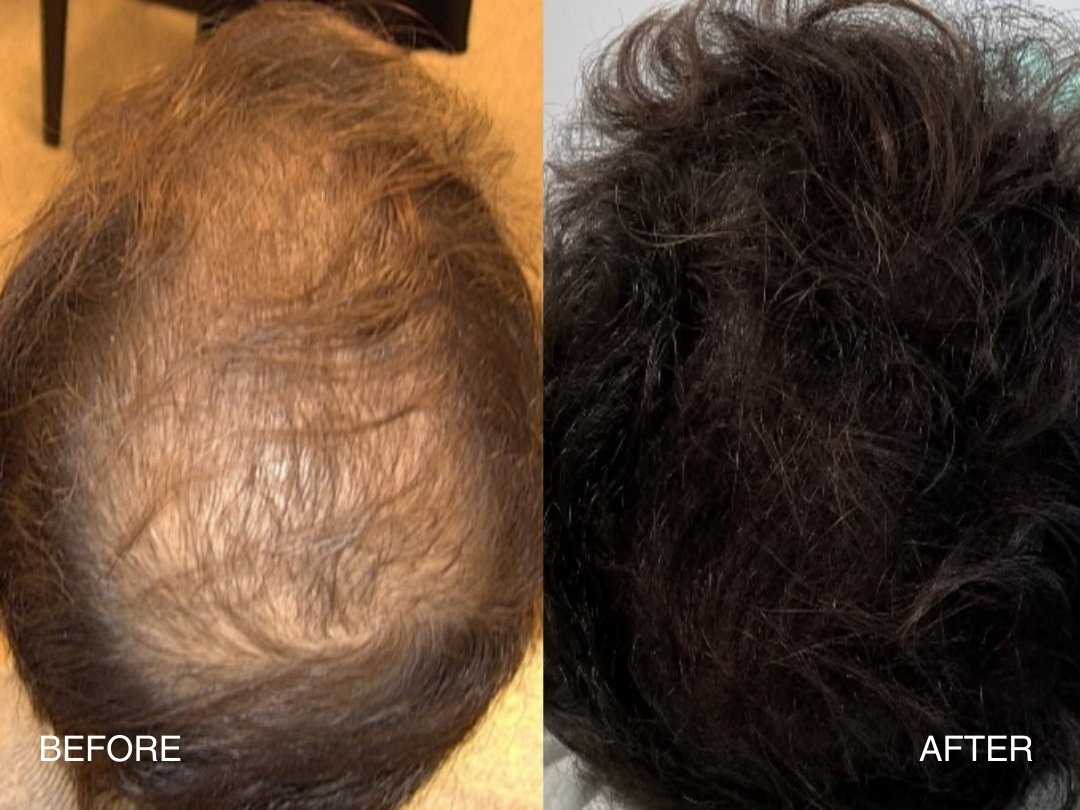 nano fat hair restoration at aestha clinic nano fat hair restoration