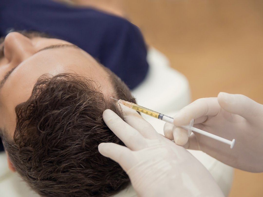 nano fat transfer for hair loss nano fat hair restoration