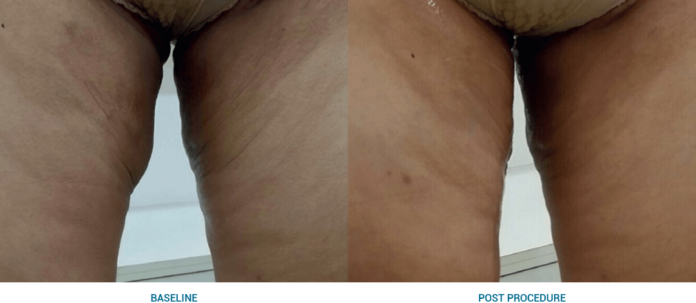 ThighsHIFU treatment collagen and weight loss