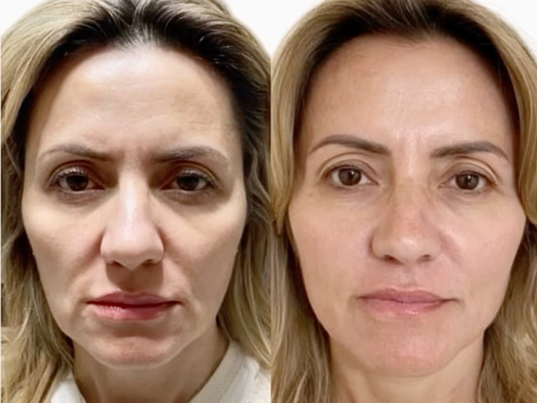 sculptra before and after
