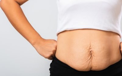 Comprehensive Solutions for GLP-1 Weight Loss and Body Skin Laxity