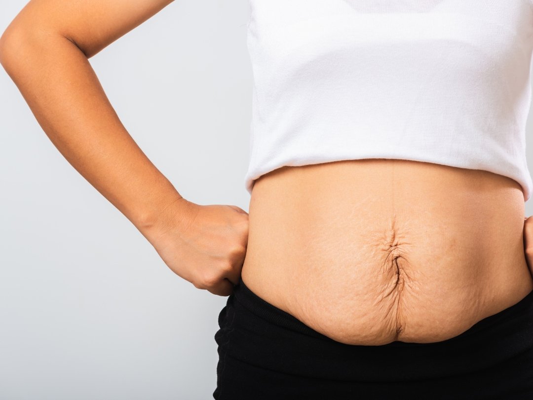 glp1 medication weight loss sagging skin