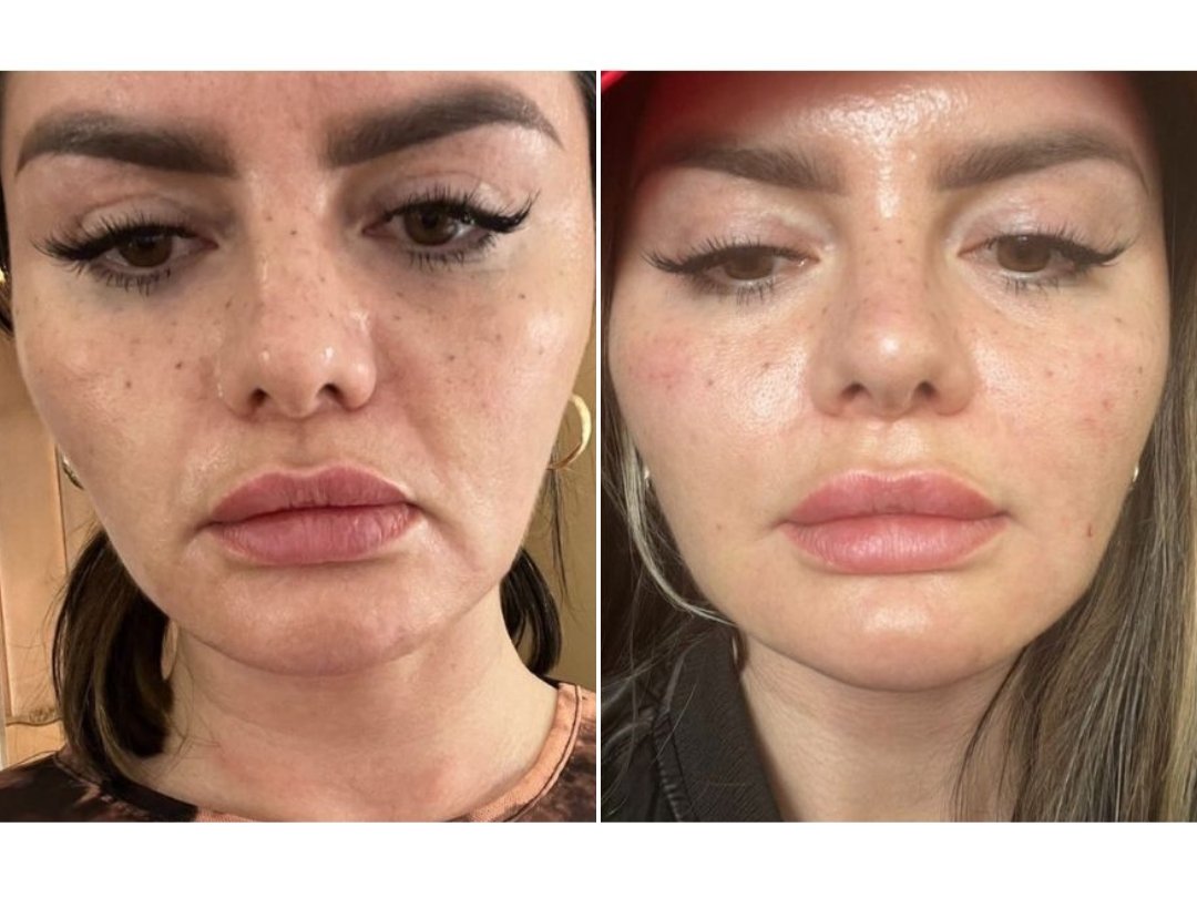 lenisna before and after