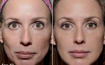 Protecting Your Face During GLP-1 Weight Loss