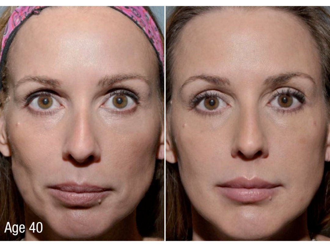 sculptra before and after