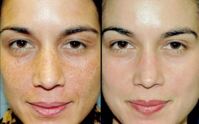 Reverse Sun Damage & Inflammaging: The Triple-Action Approach with VI Peel, Polynucleotides & PRP