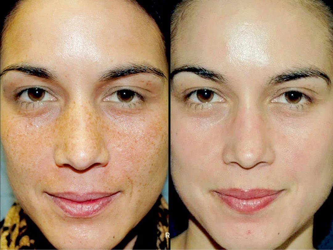 VI peel sun damage