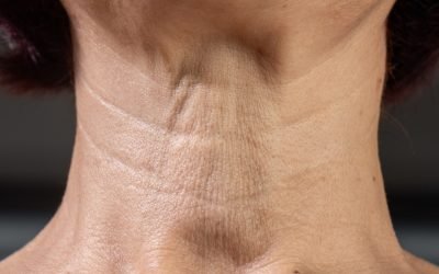 Maximising Your Biostimulator Results: The Powerful Combination of Radiesse and Ultraformer