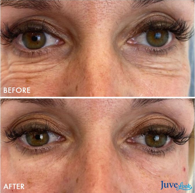 juvelook_before_and_after_1