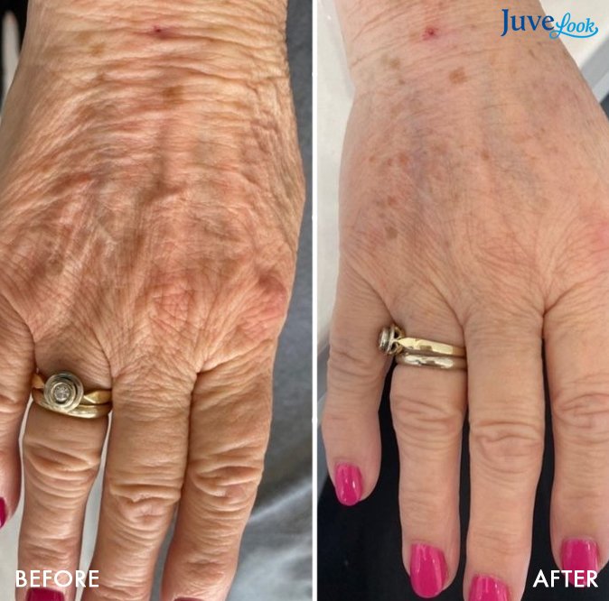 juvelook_before_and_after_2