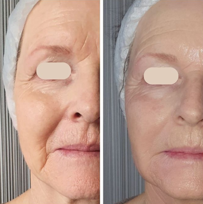 lenisna before and after(2)