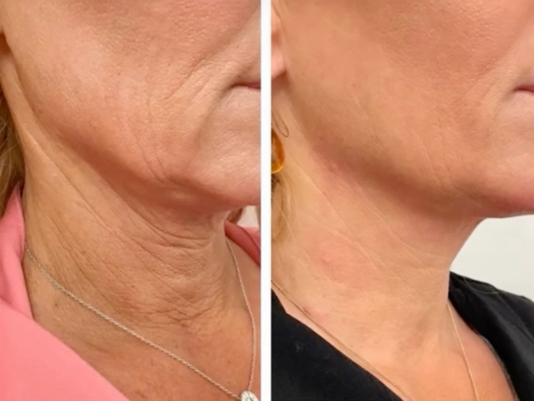 radiesse and ultraformer neck rejuvenation
