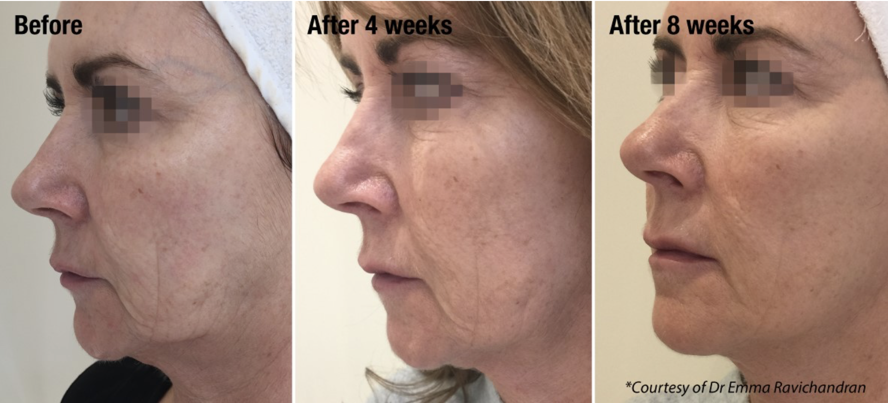 profhilo before and after